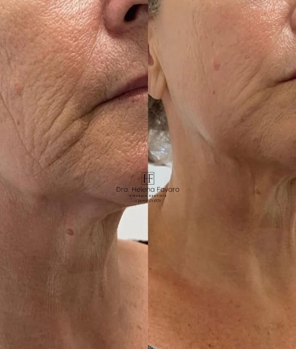Comparativo de região mandibular e pescoço com melhora visível da firmeza e do contorno.