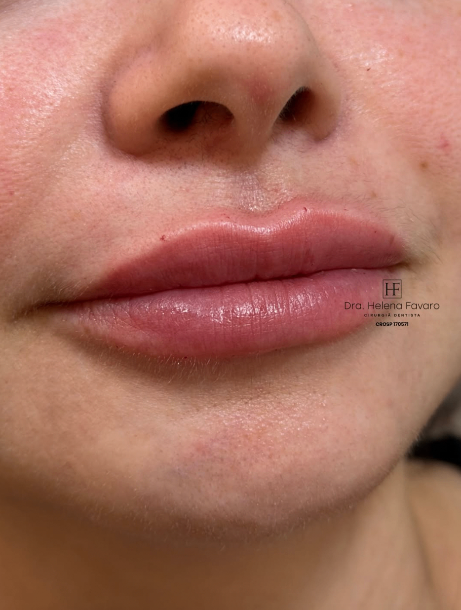 Resultado labial com contorno delicado e equilíbrio do volume.