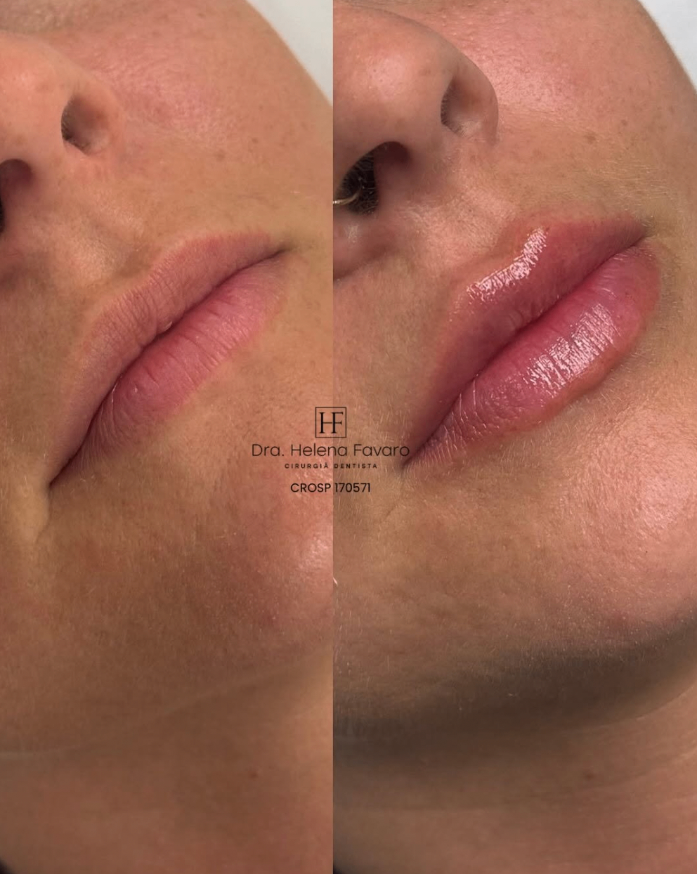 Antes e depois de preenchimento labial com brilho e volume delicado.