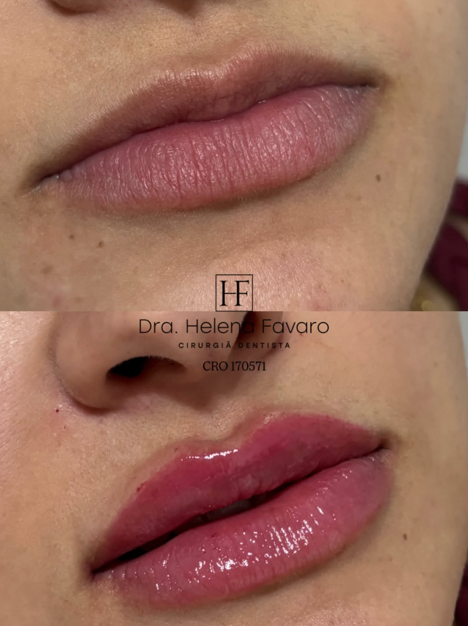 Antes e depois de lábios com acabamento natural, viço e definição.
