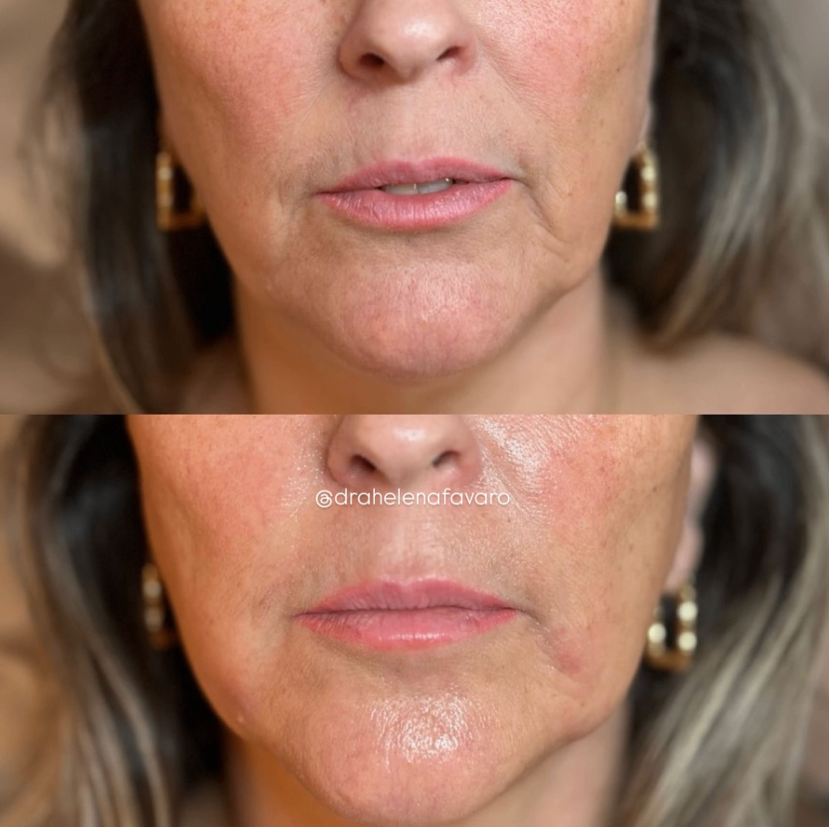 Comparativo facial mostrando melhora do contorno inferior e rejuvenescimento ao redor da boca.