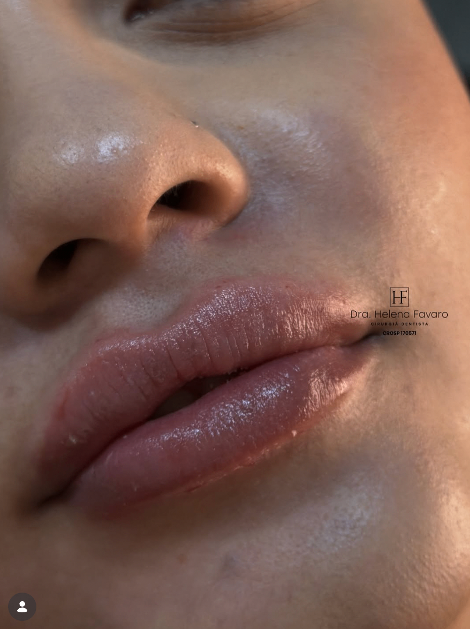Resultado de preenchimento labial com acabamento natural e brilho suave.