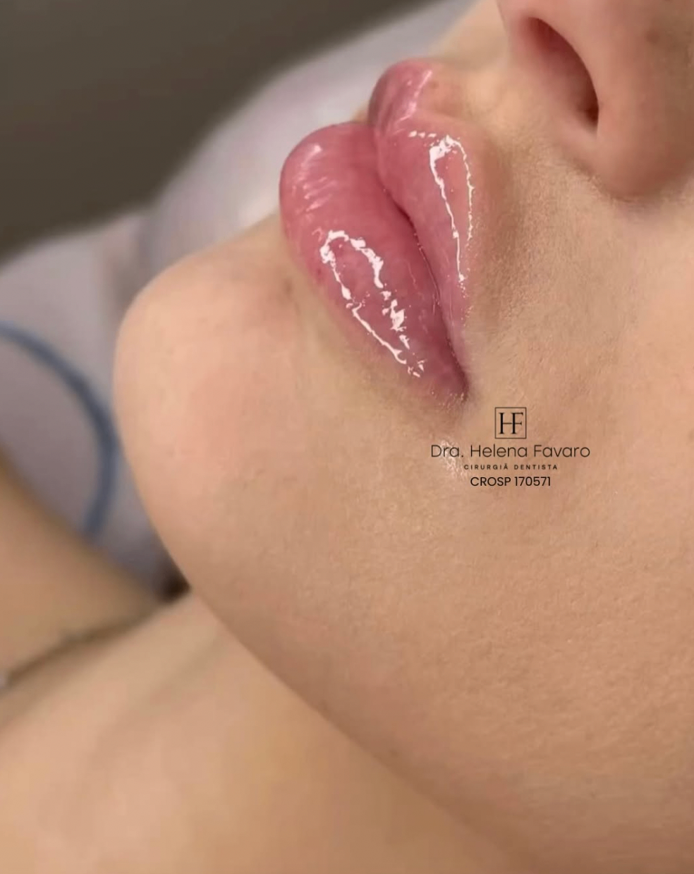 Resultado de harmonização labial com aspecto luminoso e acabamento premium.